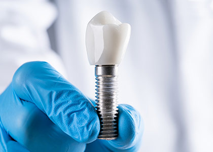 مزایای ایمپلنت دندان (کاشت دندان)