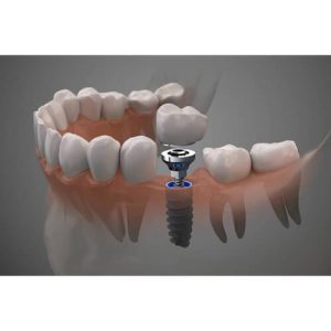 ایمپلنت دندان چیست؟ و چند جلسه زمان میبرد؟