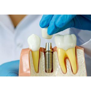 ایمپیلنت چقدر زمان می برد؟