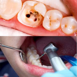 در صورت برطرف شدن درد دندان نیاز به عصب کشی است؟