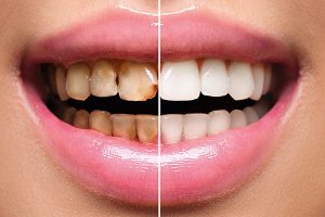 ترمیم دندان پوسیده در خانه + ترمیم دندان شکسته