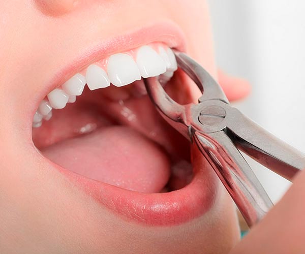 کشیدن دندان