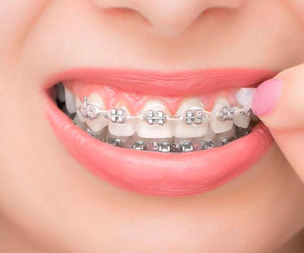 ارتودنسی دندان