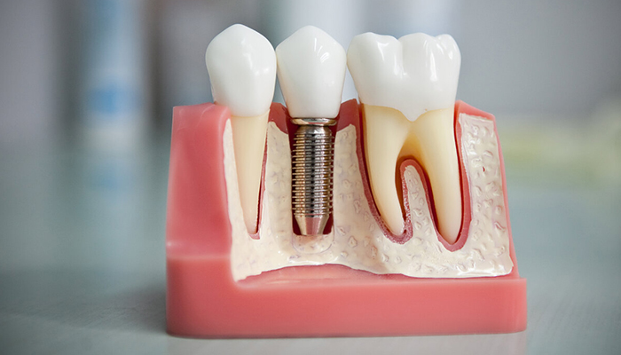 مراحل ایمپلنت دندان