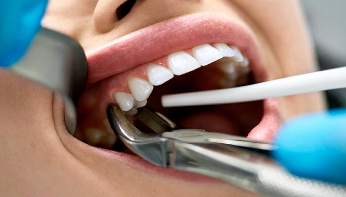 دلایل کشیدن دندان