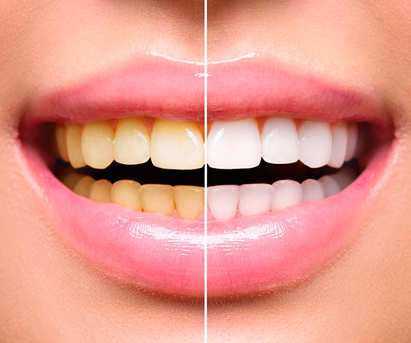 ترمیم دندان چیست؟