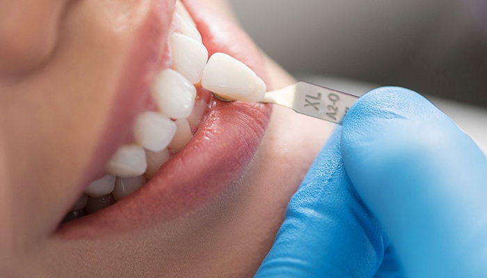 هزینه کاشت ایمپلنت دندان