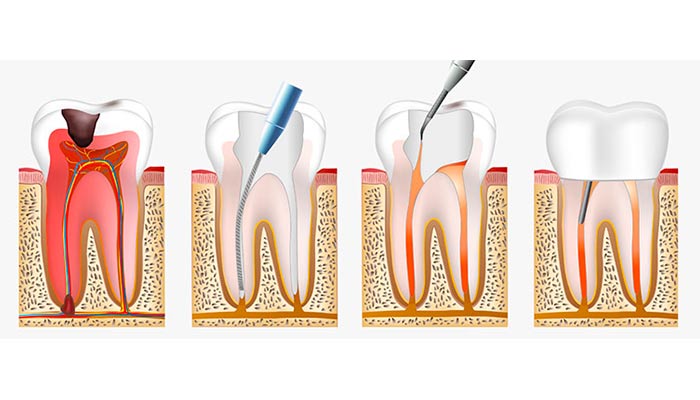 مراحل عصب کشی دندان