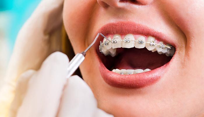 چه زمانی نیاز به ارتودنسی دندان است؟