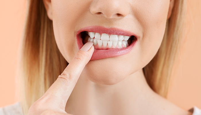 معایب روکش دندان