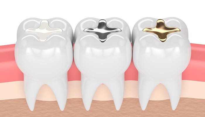 ترمیم دندان باچه موادی انجام میشود؟