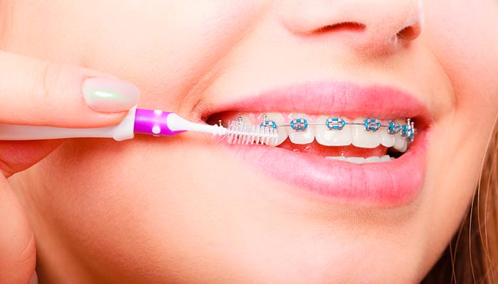 طول درمان ارتودنسی دندان