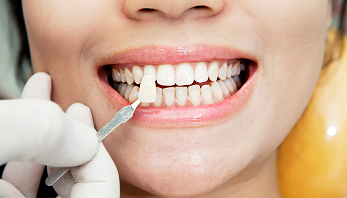 عوارض کامپوزیت دندان