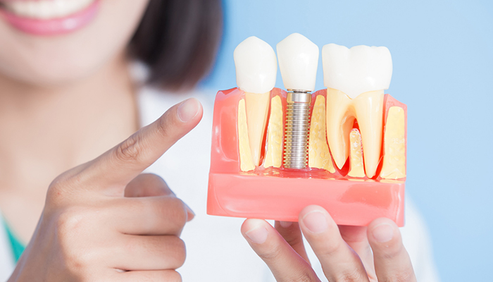 انواع ایمپلنت از نظر سطح بدنه