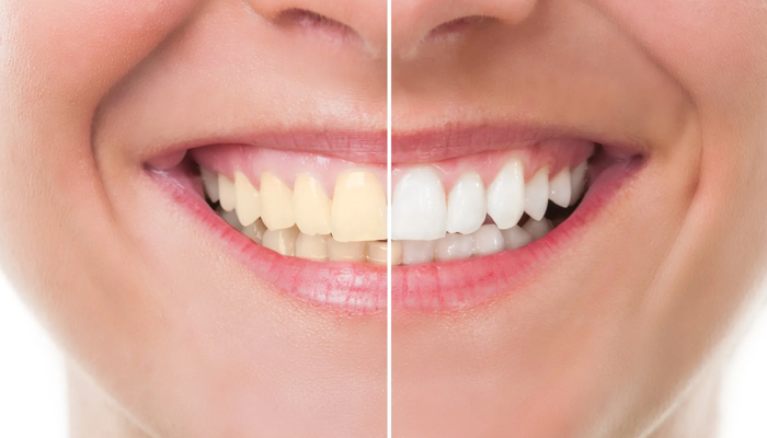 تفاوت کامپوزیت و لمینت دندان در چیست؟