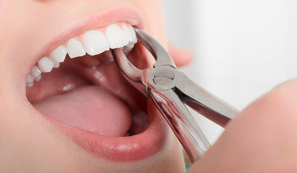 کشیدن دندان