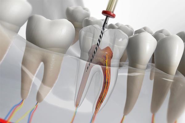 آیا بعد از عصب کشی دندان درد دارد؟