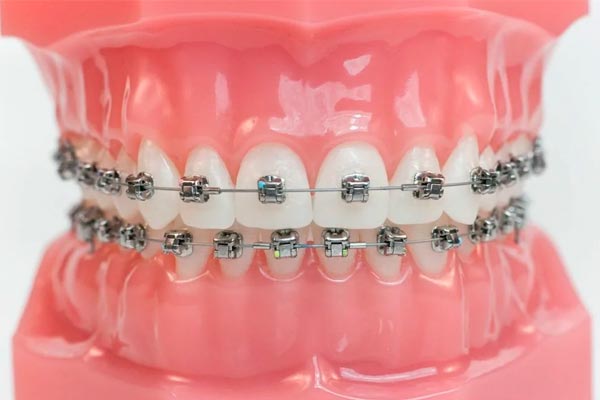 آیا ارتودنسی دندان درد دارد؟