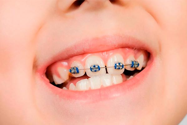 دلایل انجام ارتودنسی در سنین پایین