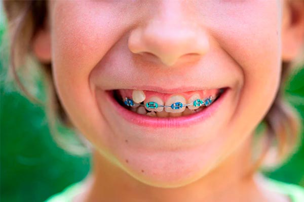 بهترین سن برای ارتودنسی چه سنی است