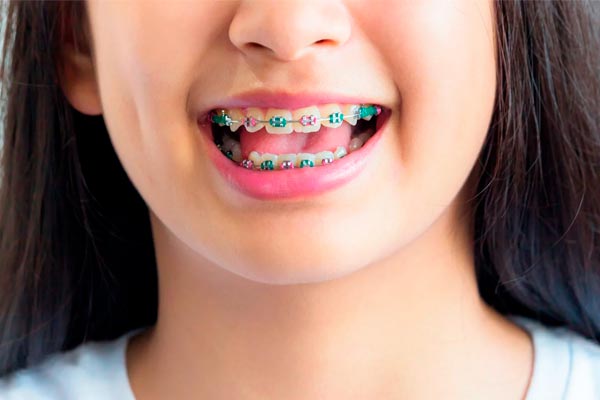 هزینه ارتودنسی کودکان چقدر است