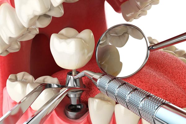 ایمپلنت دندان چقدر طول می‌کشد؟