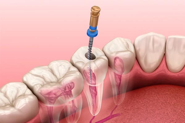 دلایل درد در مدت عصب کشی دندان