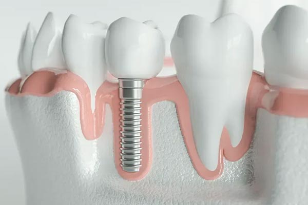 عوامل موثر بر مدت زمان تکمیل ایمپلنت دندان