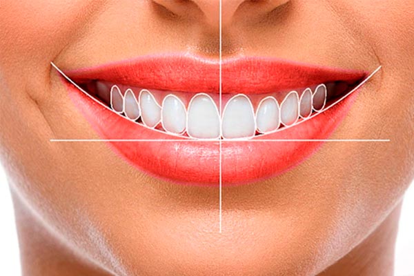 لمینت دندان