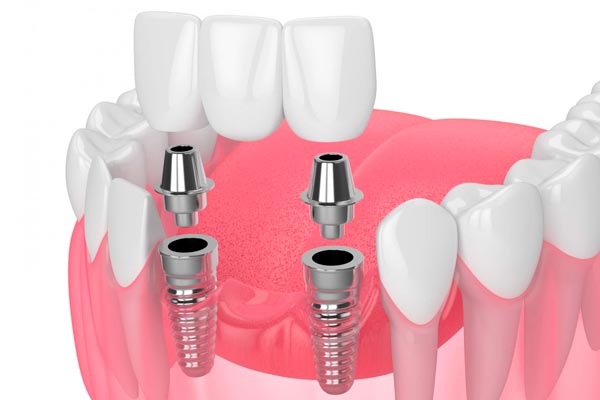 مراحل اصلی تکمیل ایمپلنت دندان