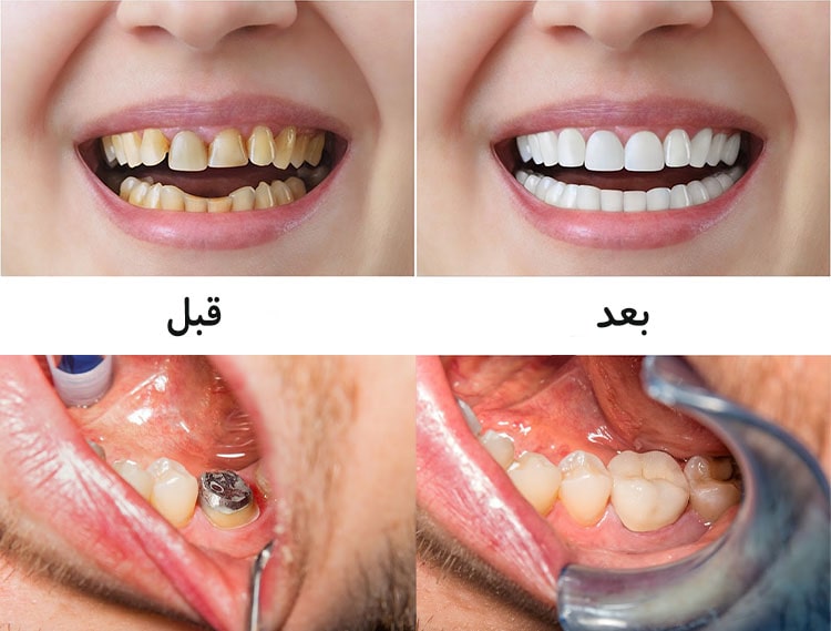 هزینه روکش دندان